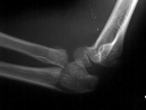 Figure 3 _Olecranon fracture with radial neck.jpg